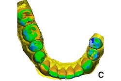 2025 05 03 3 D Printed Restorations 400
