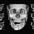 Ct Fractured Jaw Suttha B