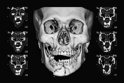 Ct Fractured Jaw Suttha B
