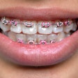 Braces Pink Bands