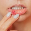 Mouth Ulcer Woman ольга шефер