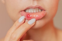 Mouth Ulcer Woman ольга шефер
