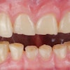 Worn Teeth Thitinon
