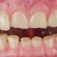 Worn Teeth Thitinon