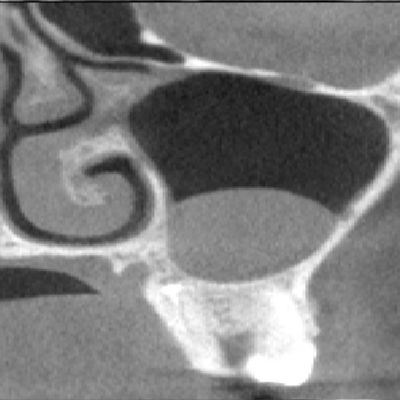 2025 06 05 Imaging Insider Maxillary Sinus Pathologies 400