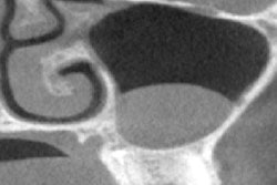 2025 06 05 Imaging Insider Maxillary Sinus Pathologies 400