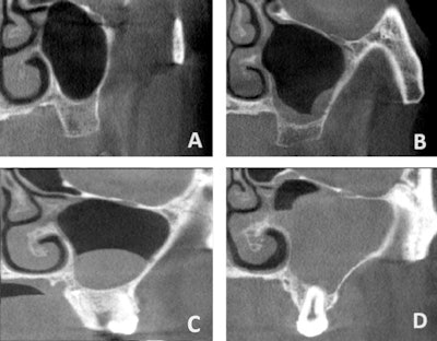 Maxillary sinus conditions identified via CBCT. (A) Clear sinus, (B) mucosal thickening, (C) cyst/polyp, (D) opacification (≥ 50% of sinus volume). Images and captions courtesy of Küçükkurt. Licensed under CC BY-NC-ND 4.0.