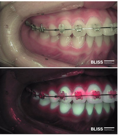 In a 13-year-old patient, BLISS biofluorescence imaging shows red fluorescence around brackets on the maxillary teeth, indicating biofilm accumulation despite relatively good brushing of the mandibular teeth.