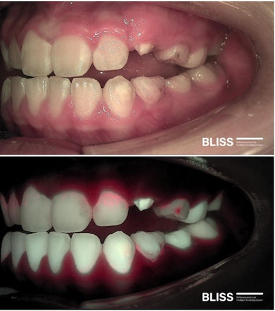 In an 11-year-old patient with mixed dentition, BLISS biofluorescence imaging reveals red fluorescence, indicating the presence of oral biofilm and carious lesions. Images and captions courtesy of AIOBIO.