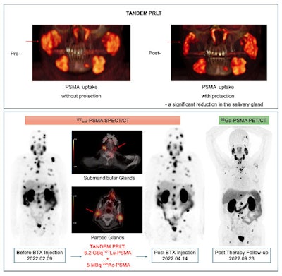 In a patient, pretreatment PET/CT demonstrated comparable tracer uptake. Postinjection SPECT/CT images revealed a marked reduction in PSMA radioligand uptake.
