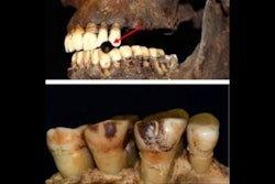 2025 07 03 Smoking Tooth Effects 400