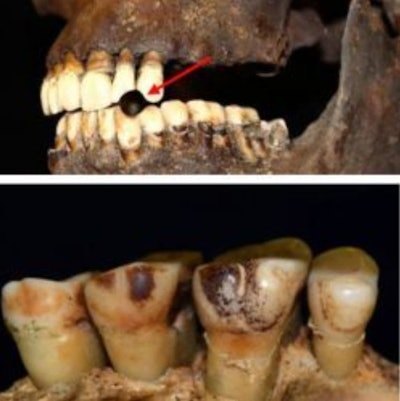 Top: Example of pipe notch (arrowed) [SK134130, St. James’ Gardens Burial Ground, Euston, London (Image reprinted from Davies-Barrett A., Inskip S. under a CC BY license, with permission from Manchester University Press, original copyright 2024)]. Bottom: Example of staining due to smoking [SK417, Holy Trinity Church, Coventry (Image reprinted from Davies-Barrett A., Inskip S. under a CC BY license, with permission from Manchester University Press, original copyright 2024)].