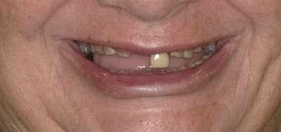 A 71-year-old woman presented to our office with significant anxiety. According to her, her father, while serving in the U.S. military, died in a dental chair. She suffered from intense dental fear her entire life as a result. Images and captions courtesy of Dr. Ankur Gupta.