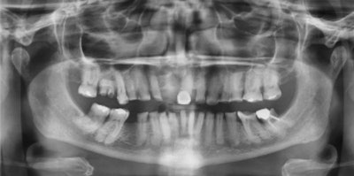 After a thorough dental exam, a radiographic exam, and a review of her history and objectives, we determined that all of her remaining teeth should be extracted and replaced with an implant-retained overdenture. Judging by her radiographs, I anticipated that the extractions would be difficult and time-consuming. She refused to be “put to sleep” for the procedure.