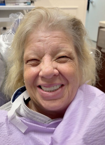 After several technically difficult appointments, the patient now enjoys a finished product. Her level of gratitude is off the charts, and she has repeatedly told us that we “saved her life.” When asked if the glasses made a difference, she responded, “It made all the difference.”