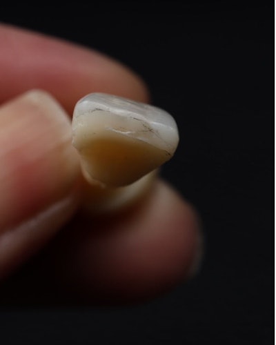 Figure 3: An incisal view to evaluate lobes.