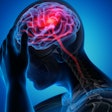 Brain Stroke