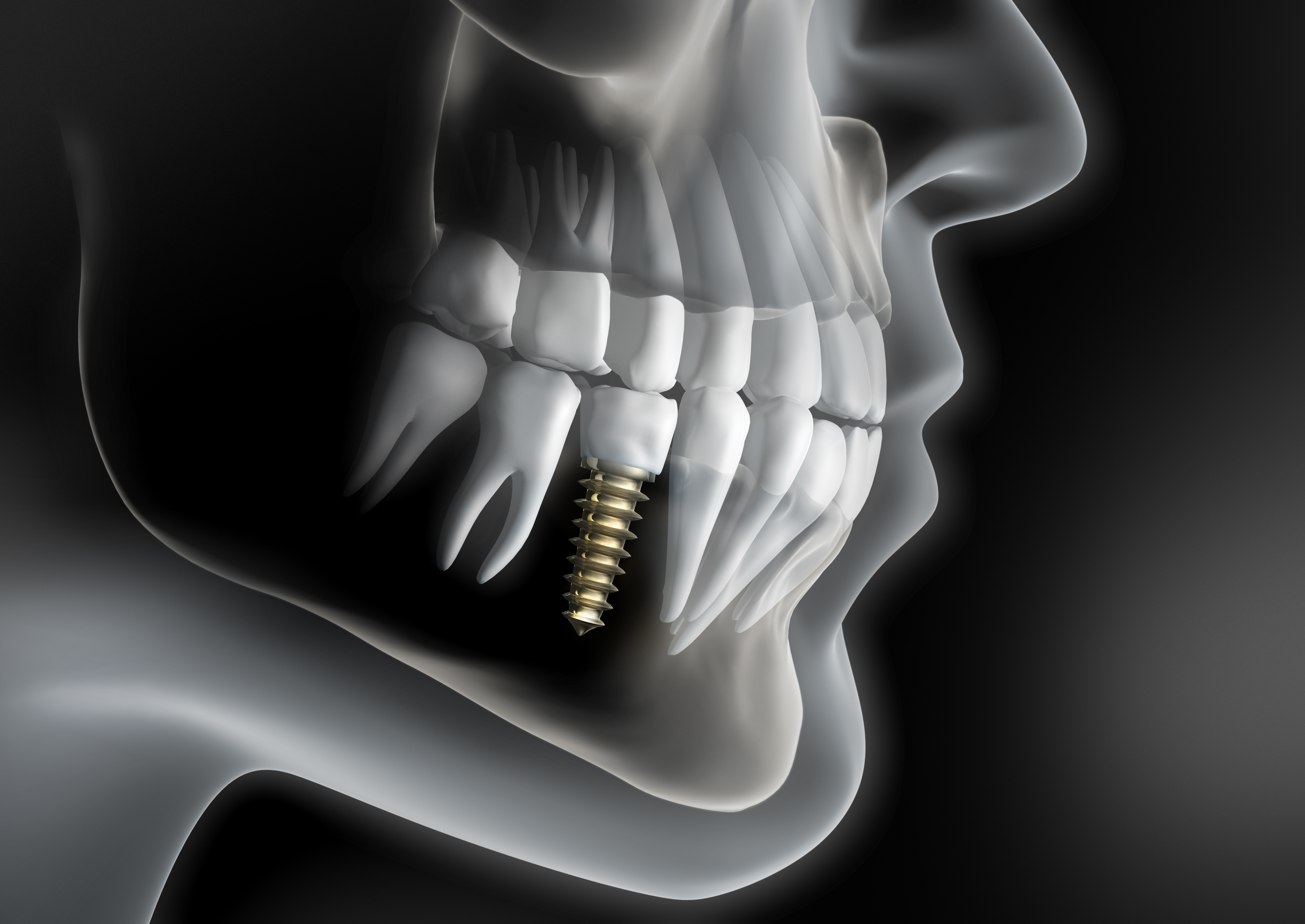Implant 3 D2