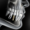 Implant 3 D2
