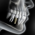 Implant 3 D2