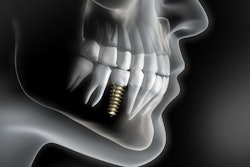 Implant 3 D2