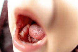 Molar Erupting Troyanphoto