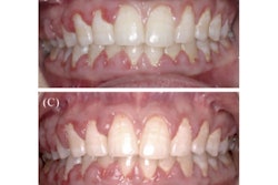 2025 07 07 Kidney Drug Gingival Growth 400