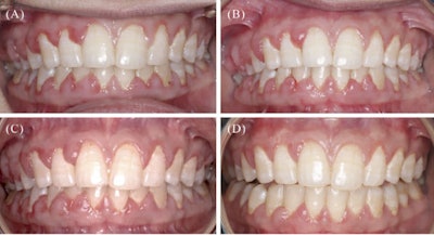 Clinical images. (A) At initial presentation (January 2024); (B) one month after initial debridement and oral hygiene instruction (February 2024); (C) following two more debridement sessions (April 2024); (D) one month following cessation of voclosporin therapy (June 2024).