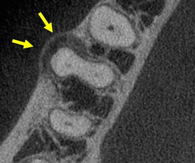 Figure 2: CBCT, axial view, tooth #30.