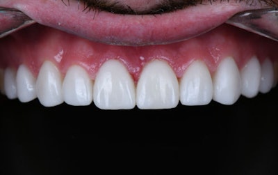 Figure 12: Immediate post-op with 3D-printed veneers.