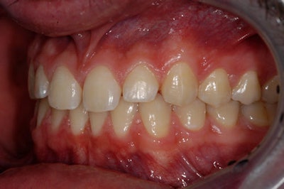 Figure 4: Left facial view (pre-op).