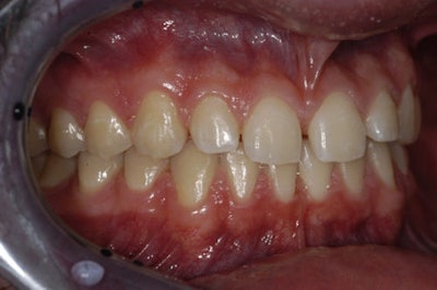 Figure 3: Right facial view (pre-op).