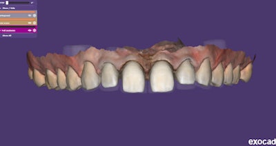 Figure 8: Digital impression of prepared teeth.