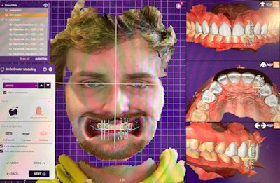 Figure 6A: Initial design in Exocad discussed with the patient.