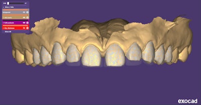 Figure 6: Pre-op digital impression of teeth #4-10.