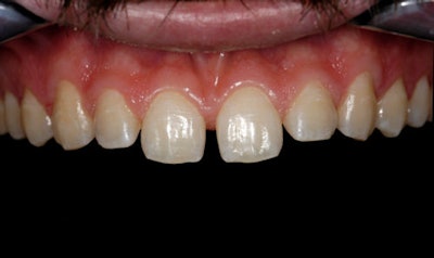 Figure 5: Close-up of retracted maxillary arch.