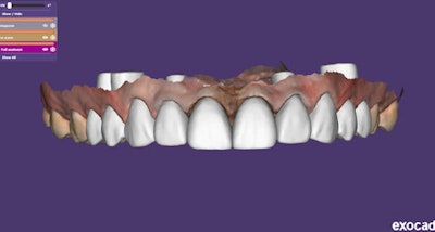 Figure 9: Veneer design -- improved aesthetics with distal preps #7, #8, #9, #10, and soft-tissue changes.