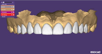 Figure 7: Veneer mock-up -- no prep or soft-tissue changes.