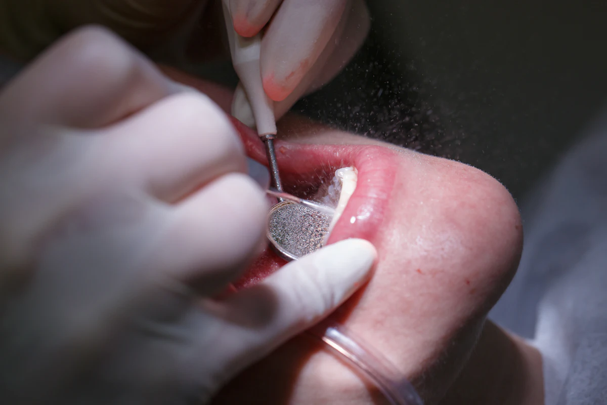 Ozonated water may treat pericoronitis