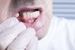 Missing Tooth Edentulism