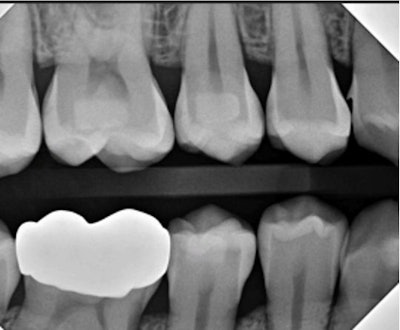 Figure 1: Quick! What’s going on with the distal of #6? It isn’t calculus.