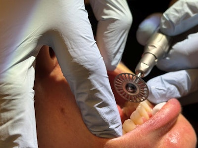 Figure 2: As hard as I try, there is just not a very comfortable way for me to hold the handpiece for lower anterior IPR instances.