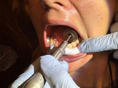 Figure 3: While it is not difficult to retract the lip, it is often impossible to guarantee that the patient will not move their tongue during these posterior upper IPR instances.