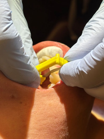 Figure 5: The “cutting” portion of the IPR strips is located within the U-shaped thumb grip, significantly reducing the potential for any soft-tissue injury.