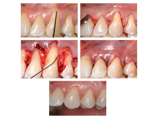 2025 09 05 Hyaluronic Acid Gingival Recession 400