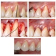 2025 09 05 Hyaluronic Acid Gingival Recession 400