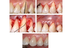 2025 09 05 Hyaluronic Acid Gingival Recession 400