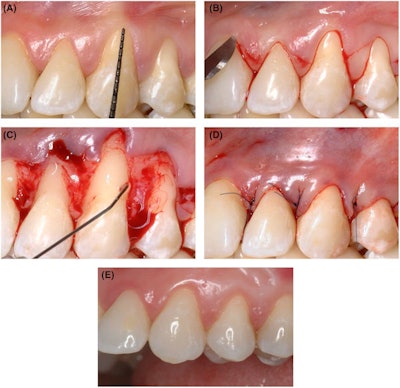 Figure 2: Clinical illustration of a multiple type 1 (RT1) gingival recession treated by coronally advanced flap in combination with HA. (A) baseline, (B) flap design; (C) split-full-split-thickness flap elevation and HA gel application; (D) flap suture; (E) clinical follow-up at 24 months.