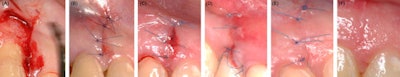 Figure 1: Clinical illustration of early healing at different time intervals at a vertical release incision site. (A) intraoperative HA application, (B) suture, (C) one day after surgery, (D) three days after surgery, (E) one week after surgery, (F) two weeks after surgery.