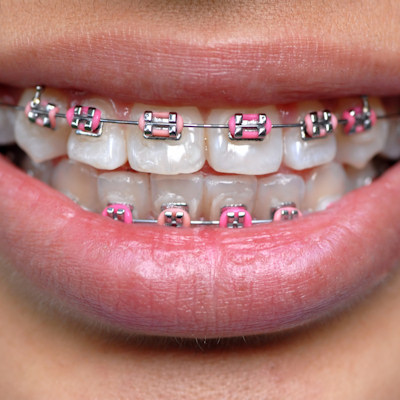 Braces Pink Bands 400